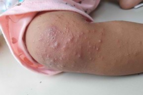 Kenali Gejala Tertular Flu Singapura, Dinkes Surabaya Imbau Masyarakat Terapkan Pola Hidup Bersih dan Sehat
