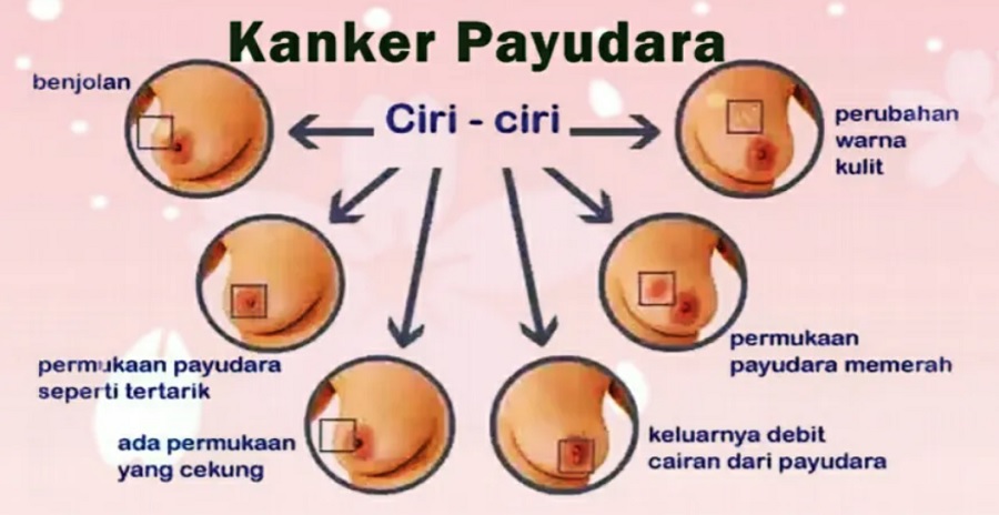 Deteksi Dini Kanker Payudara Penting untuk Tingkatkan Peluang Kesembuhan