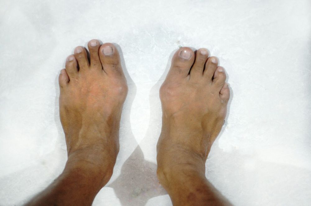 Lesi kaki di kaki menjadi indikasi seseorang terpapar Covid-19.